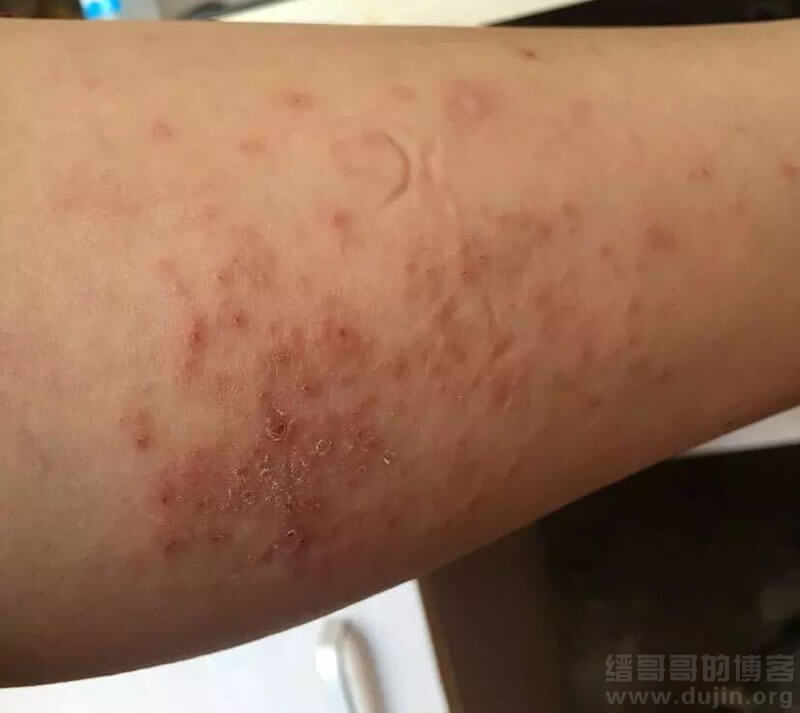 正文 小腿湿疹多发生于胫前或侧面,常对称性,呈亚急性或慢性湿疹表现